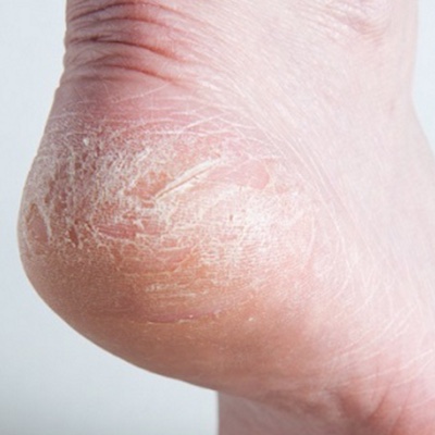 Heal Cracked Heels - 9 Natural Tips And A Healing Balm Recipe