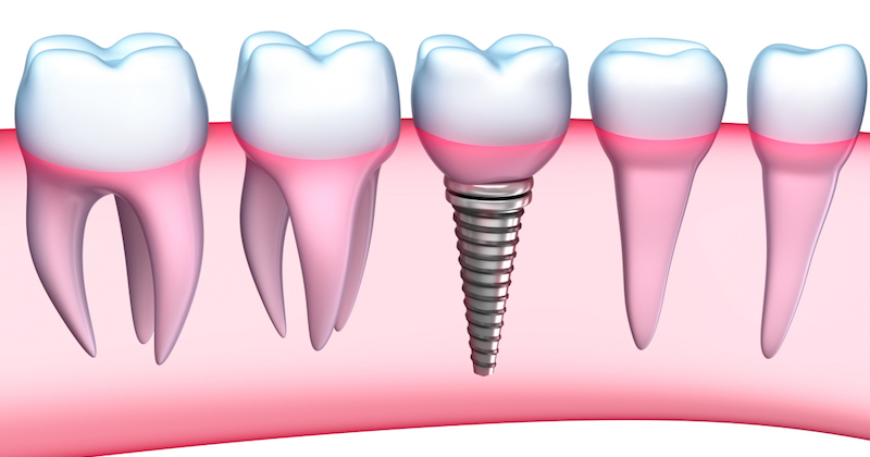 healing diet after dental implant surgery