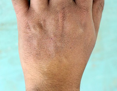 dry-skin hand