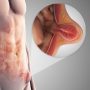 The Real Truth About Causes Of Inguinal Hernia And How You Can Prevent It