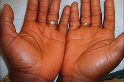 lycopenemia hands