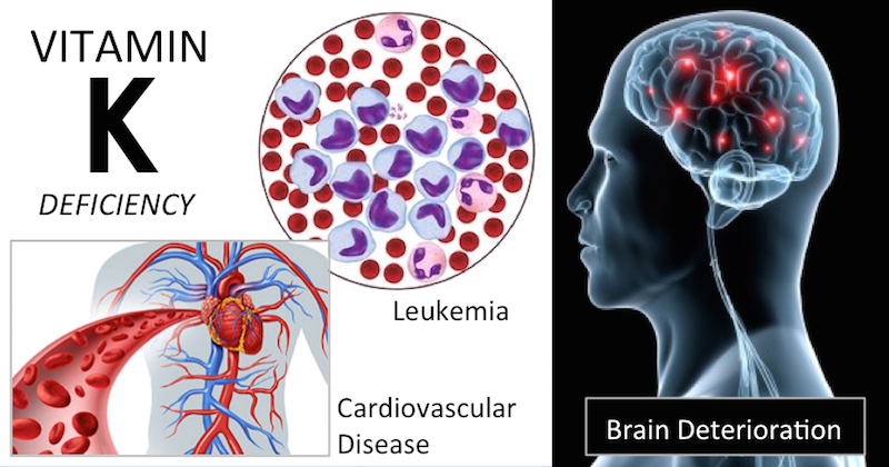 Vitamin K Deficiency Signs That Youre Not Getting Enough