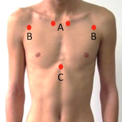 hiccups acupressure points