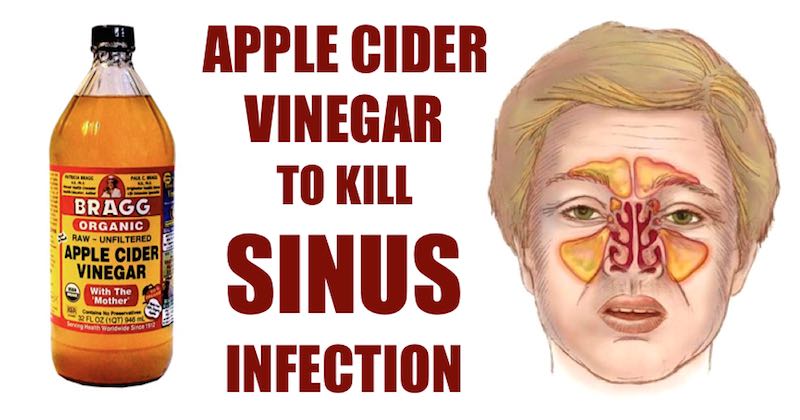 Sinus Infection Natural Remedy To Relieve Sinus Instantly   Acv Sinus Infection 1 