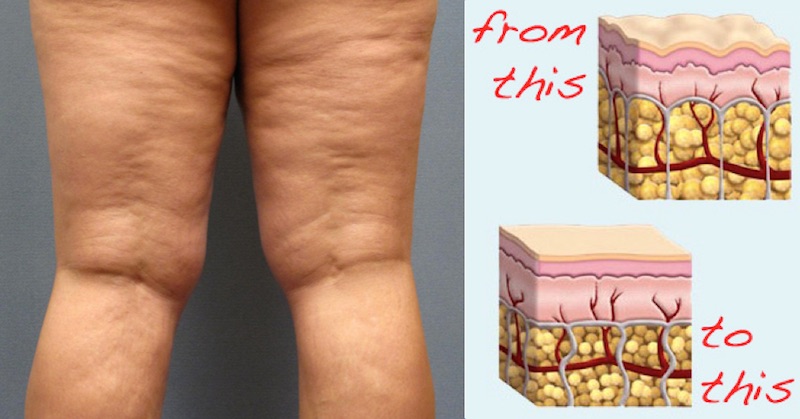 See This Report on Cellulite - Dermnet thumbnail