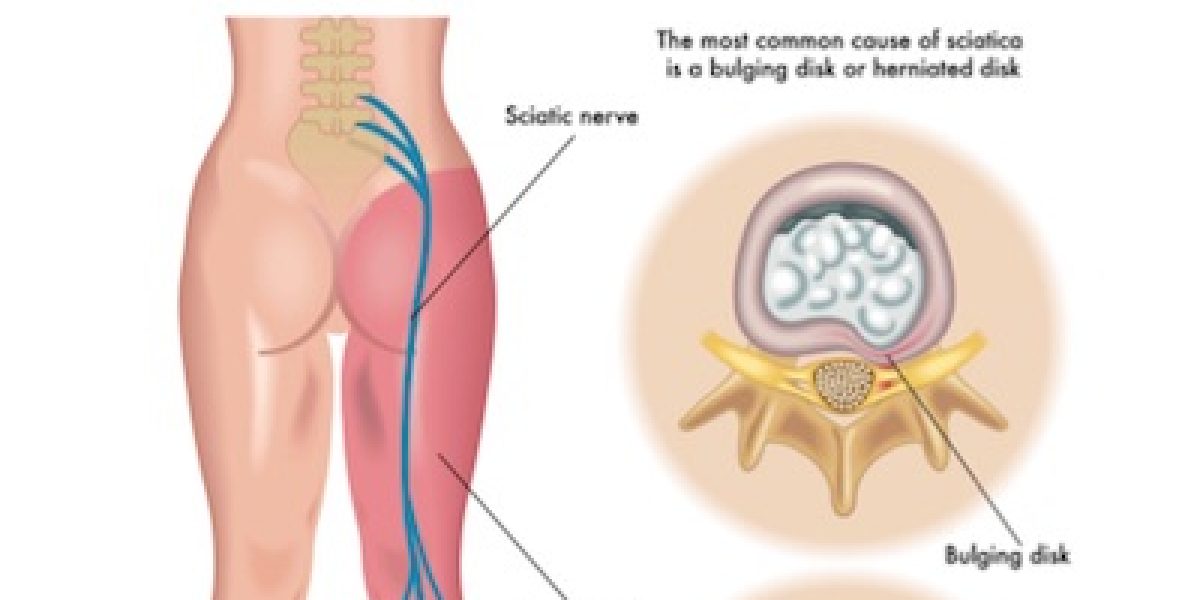 19 Ways To Relieve Sciatica And Low Back Pain Before You Take Another Pill!