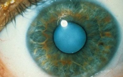 How To Use Castor Oil To Dissolve Cataracts And Get 20/20 Vision!