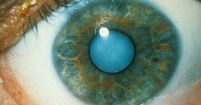 castor oil to dissolve cataracts