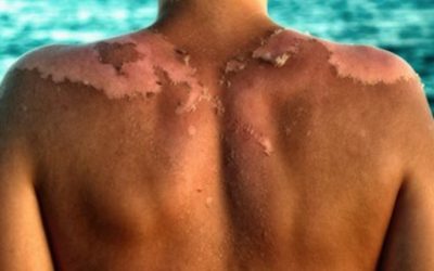 How Sunscreen Could Be Causing Skin Cancer, Not The Sun!
