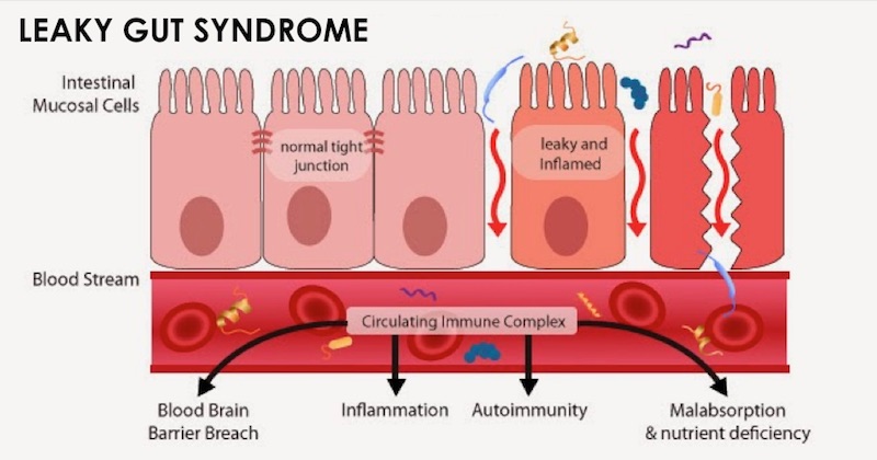 leaky gut-thyroid