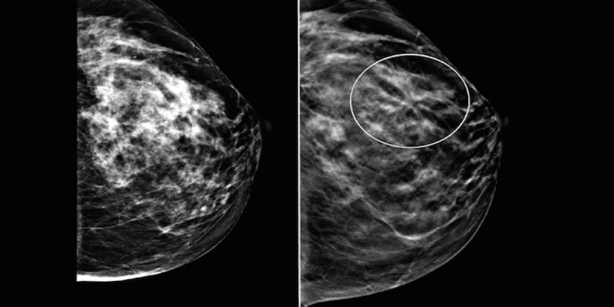 Top Medical Experts Admit That Mammography Does More Harm Than Good