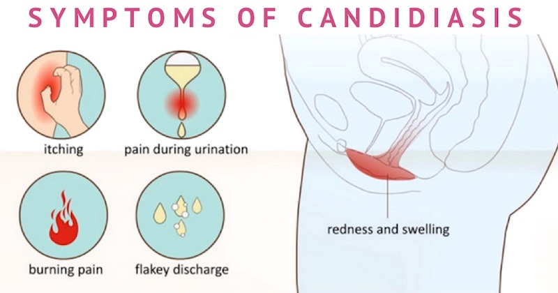 Candida Overgrowth Complete Guide On Treating A Candida Infection 