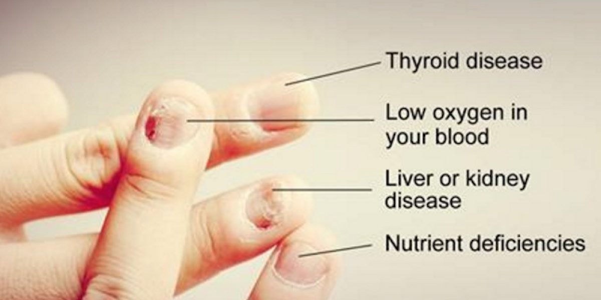 10 Nail Symptoms And What They Mean For Your Health
