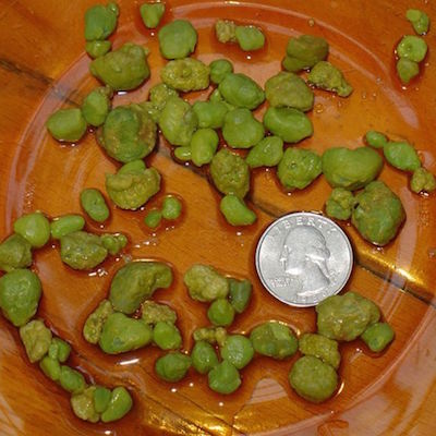 gallbladder stones