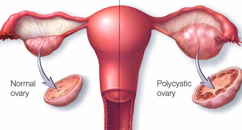 Natural Remedies For Pcos Polycystic Ovarian Syndrome