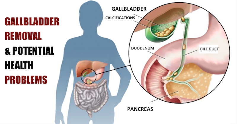 gallbladder removal