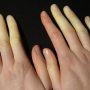 Raynaud’s Syndrome—What To Do If You Always Have Cold Hands And Cold Feet
