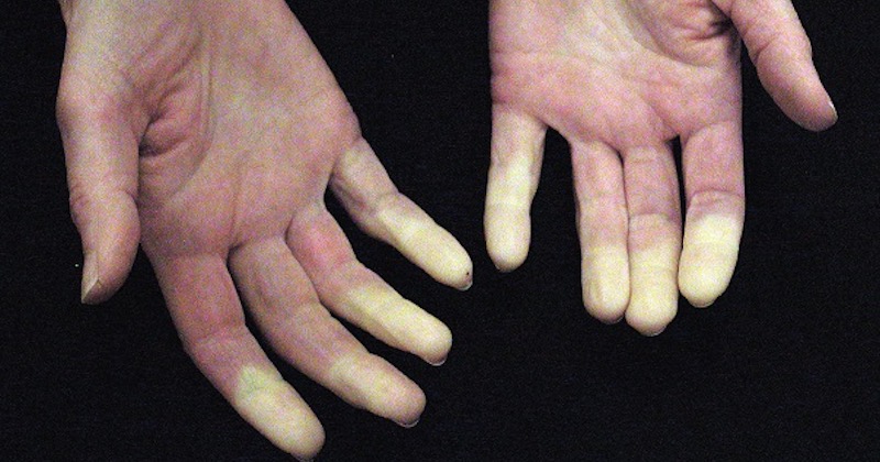 Raynaud's Syndrome - Symptoms, Causes And Natural Remedies