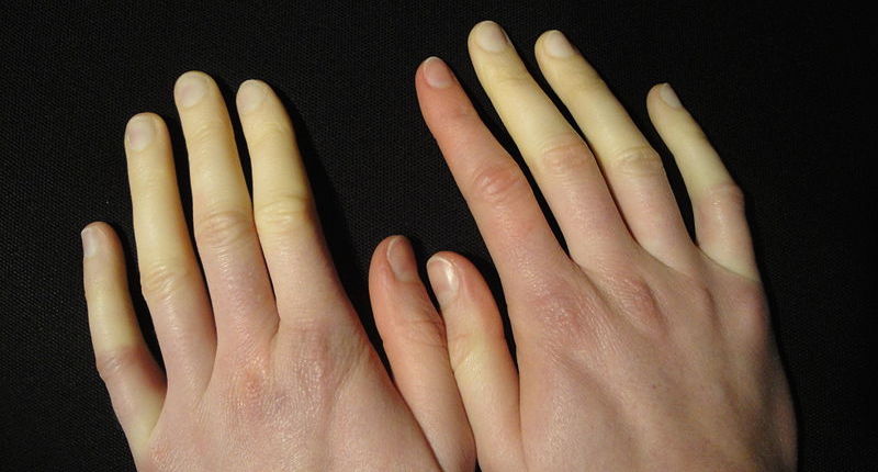 Raynaud's Syndrome