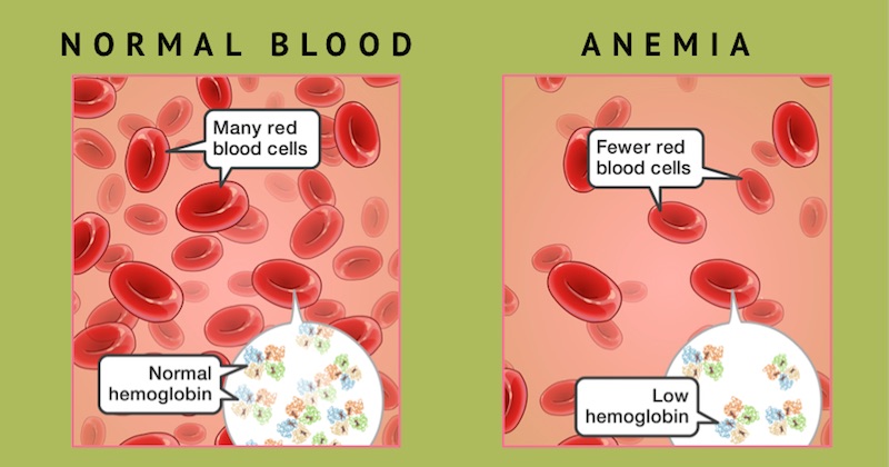 normal blood vs anemia