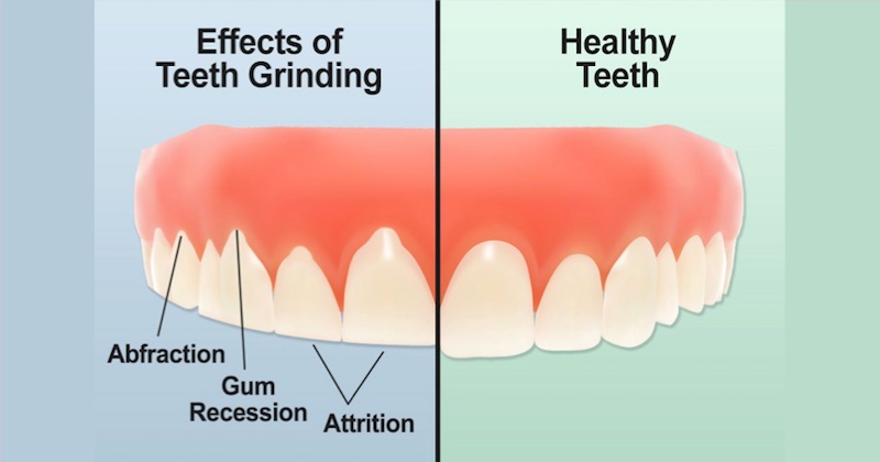 how to stop teeth grinding naturally