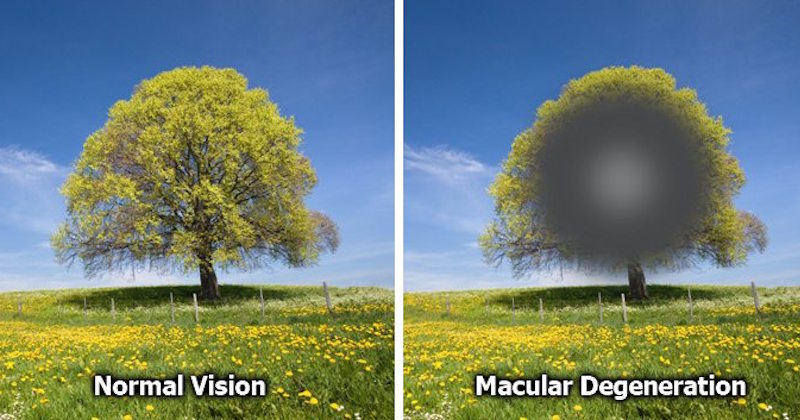 macular degeneration vision