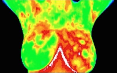 Mammography Vs Thermography For Breast Cancer Screening And Early Detection