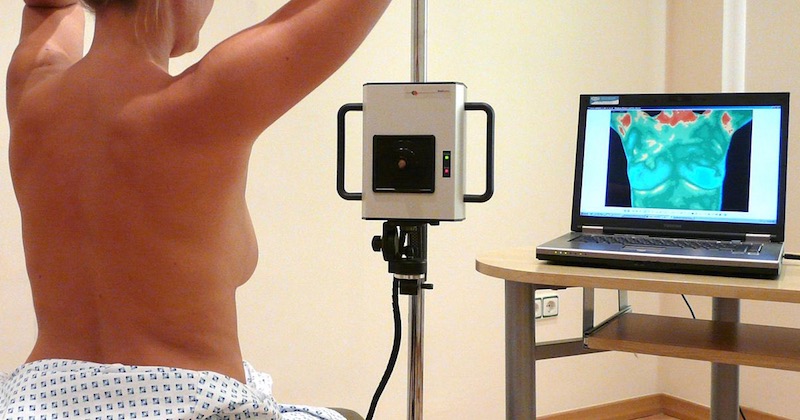 thermography for breast cancer screening