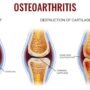 How To Use Sulforaphane To Heal Rheumatoid And Osteoarthritis Joints