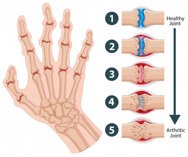 arthritis joints