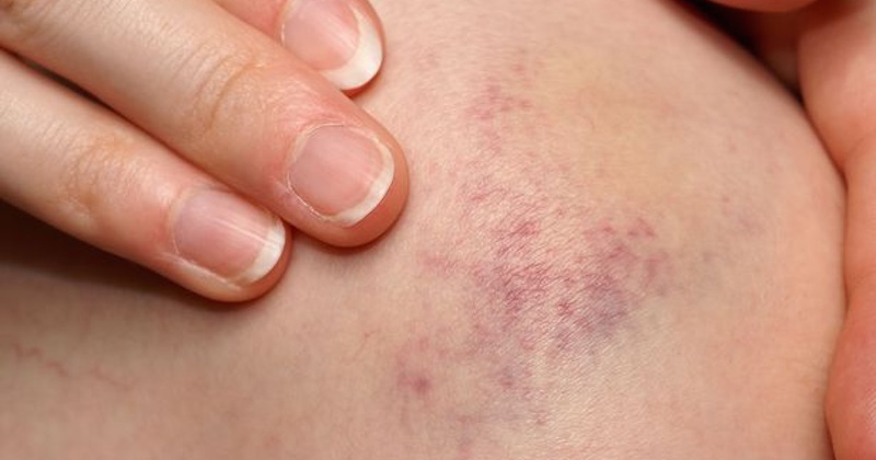 Colon Cancer Bruises