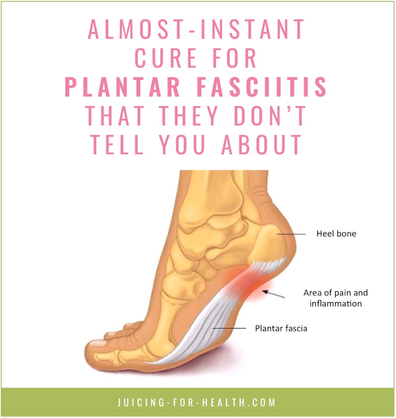 fastest way to cure plantar fasciitis