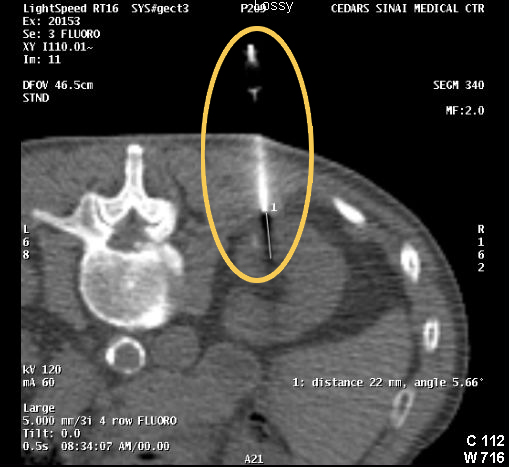 Cryoablation procedure