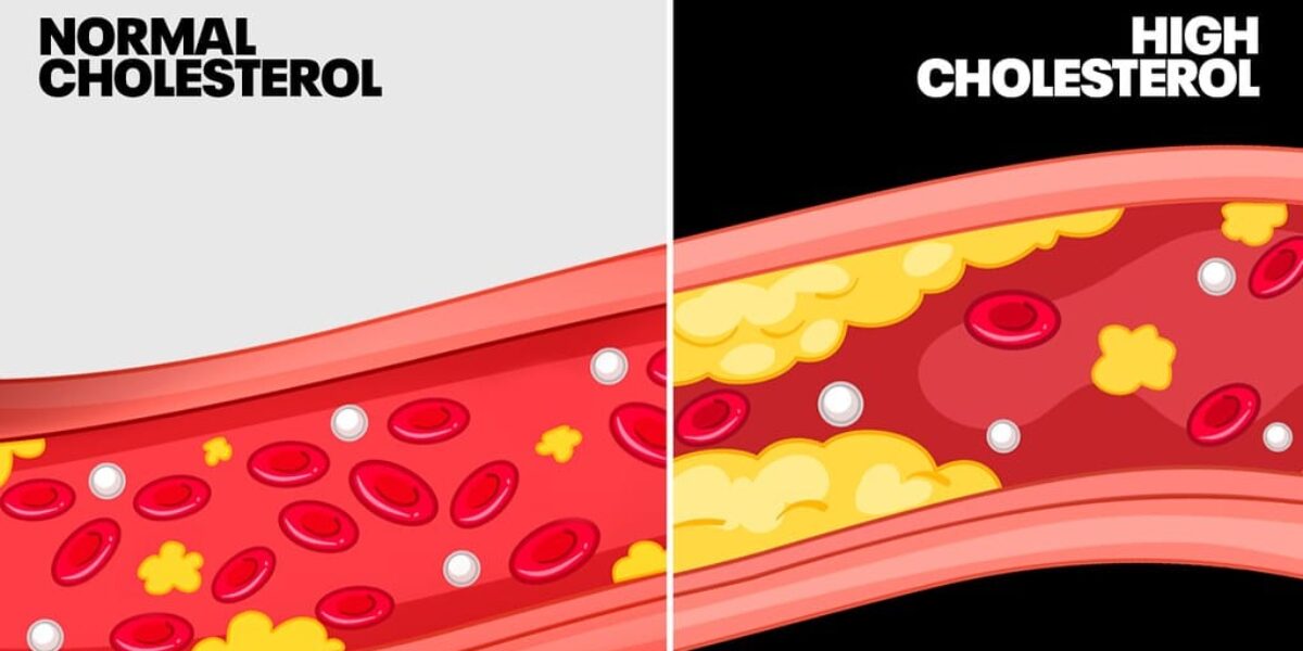 The Carnivore Diet Made Cholesterol Ooze From This Guy’s Hands
