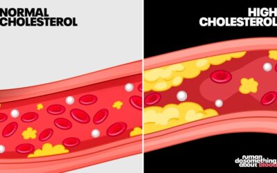 The Carnivore Diet Made Cholesterol Ooze From This Guy’s Hands