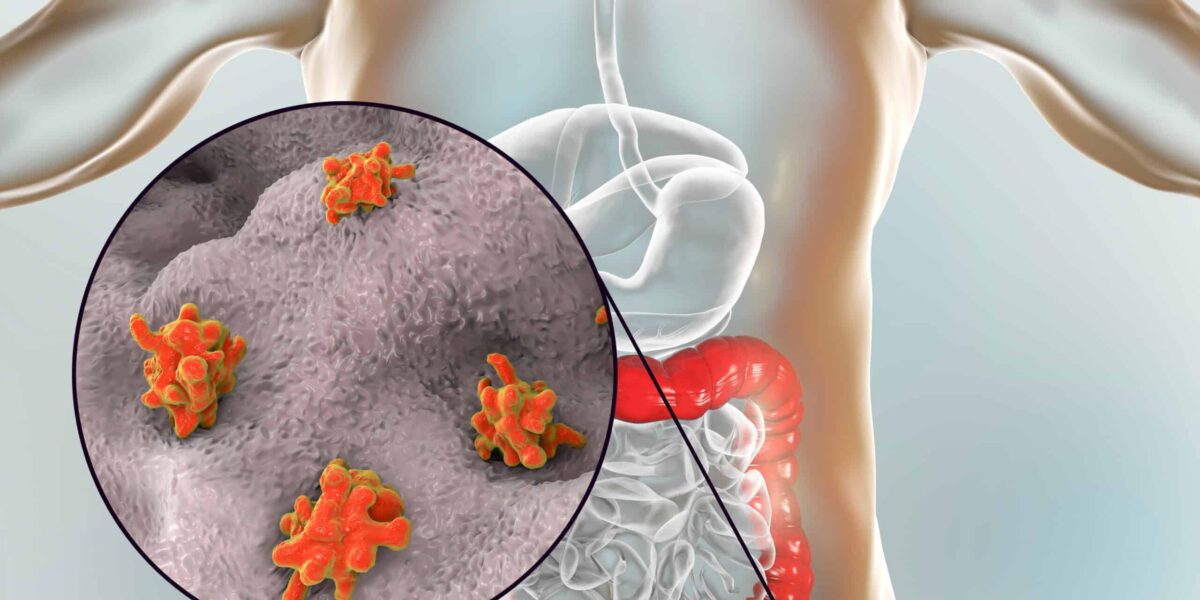 Huge Breakthrough as Scientists Pinpoint Cause of Colon Cancer in Young People