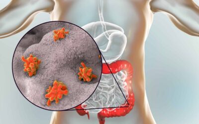 Huge Breakthrough as Scientists Pinpoint Cause of Colon Cancer in Young People