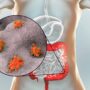 Huge Breakthrough as Scientists Pinpoint Cause of Colon Cancer in Young People