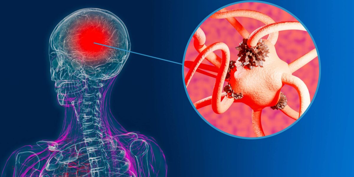 Study Claims Use Of Marijuana Could Lead To Potential Dementia Diagnosis Within The Next 5 Years