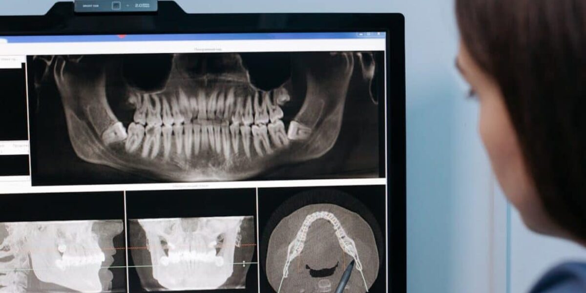 Poor Dental Hygiene Linked to Shrinkage of the Hippocampus, the Brain’s Memory Center