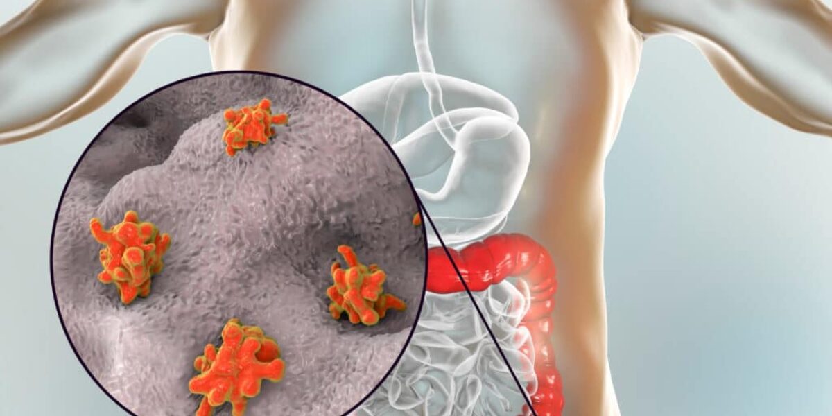 Huge Breakthrough as Scientists Pinpoint Cause of Colon Cancer in Young People