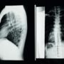 Scientists install the world’s first electronic spine to restore movement after paralysis