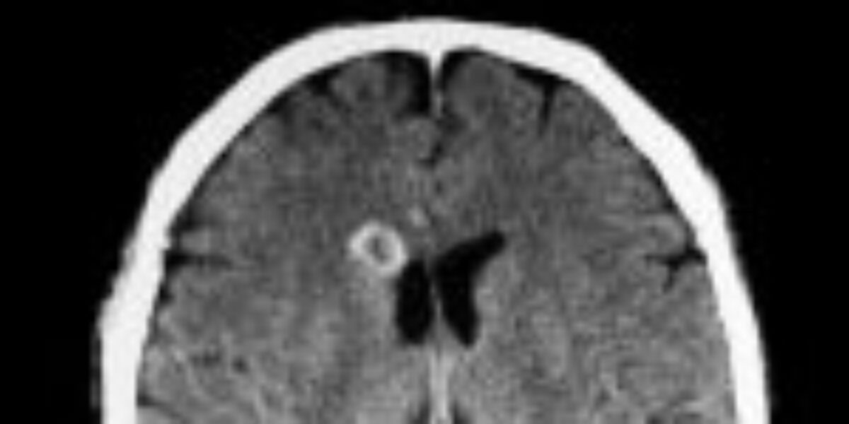 “Man Develops ‘Pork Worms’ in His Brain After Years of One Cooking Habit”