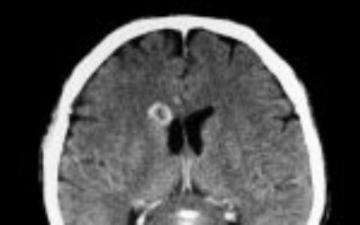 “Man Develops ‘Pork Worms’ in His Brain After Years of One Cooking Habit”