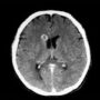 “Man Develops ‘Pork Worms’ in His Brain After Years of One Cooking Habit”