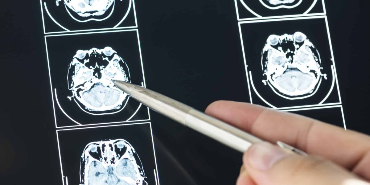 Researchers Discover Brain Cell Protein That Reverses Memory Decline Without Removing Alzheimer’s Plaques