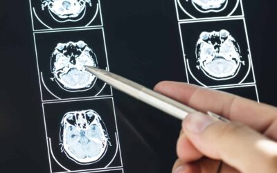 Researchers Discover Brain Cell Protein That Reverses Memory Decline Without Removing Alzheimer’s Plaques