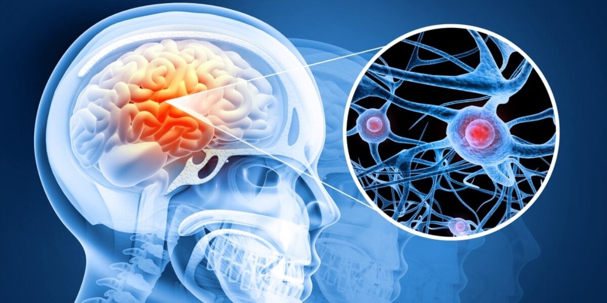 Groundbreaking Nanoparticle Technology Reverses Parkinson’s Disease in Stunning Study