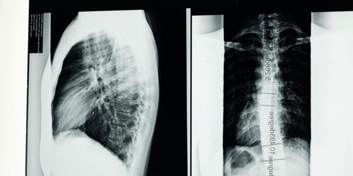 Scientists install the world’s first electronic spine to restore movement after paralysis.