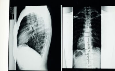 Scientists install the world’s first electronic spine to restore movement after paralysis.